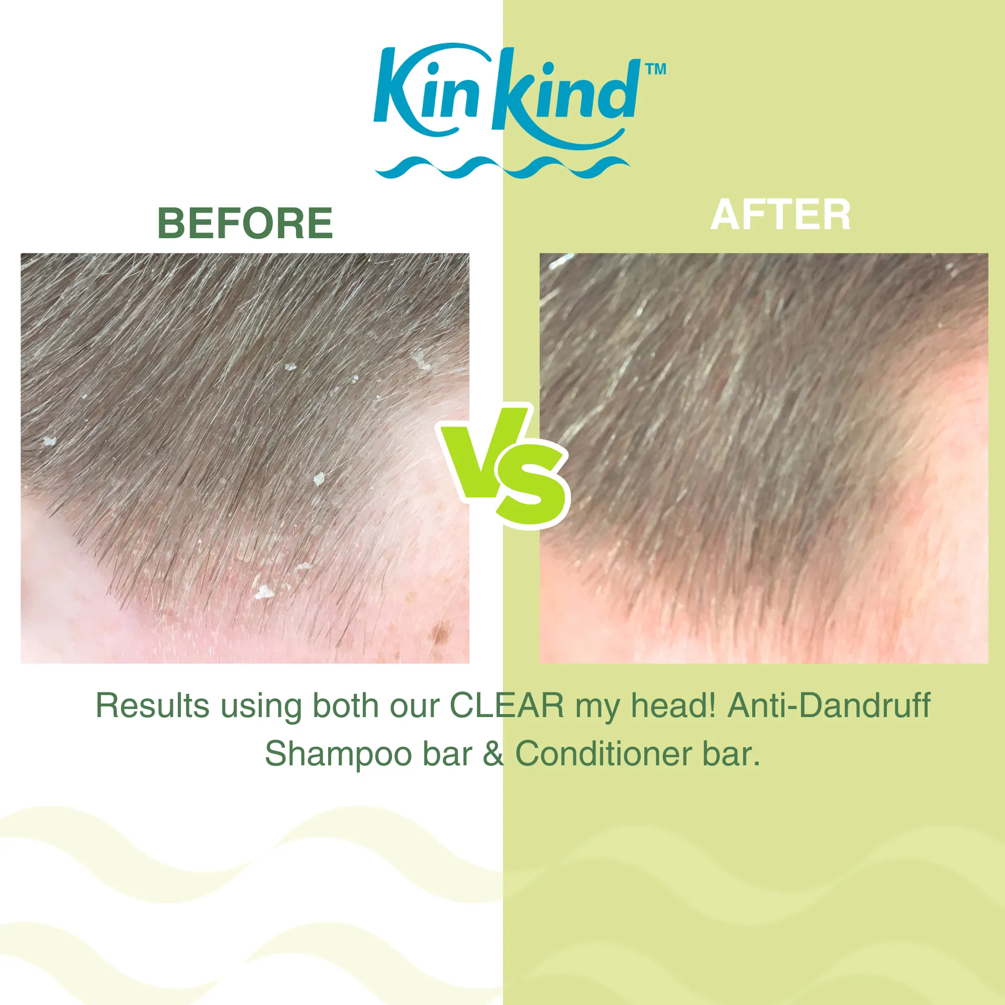CLEAR my head! Anti Dandruff Shampoo bar   Conditioner Bar for flaky scalp. Saves 4 plastic bottles!